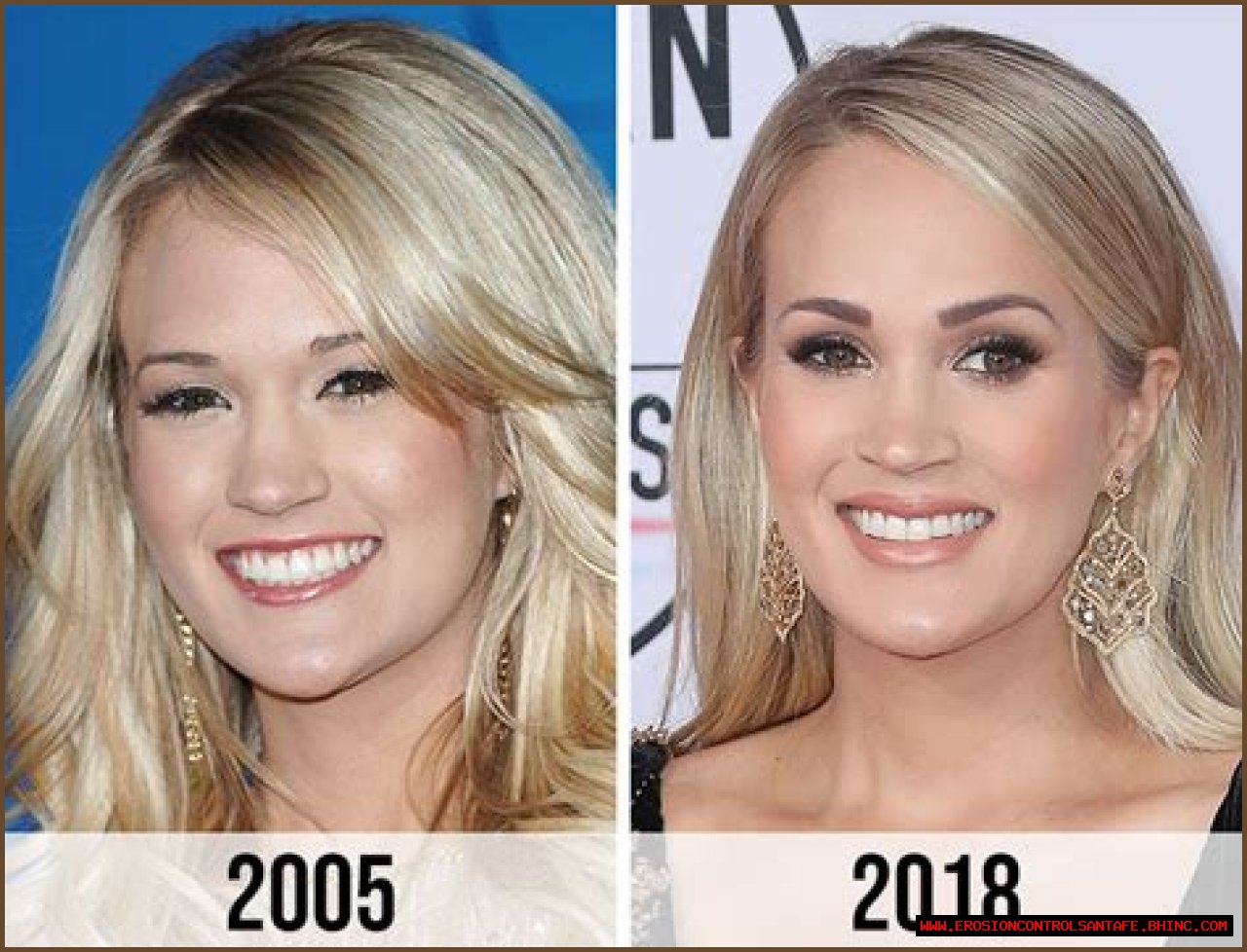 Did Carrie Underwood Get Her Lips Done? Plastic Surgery