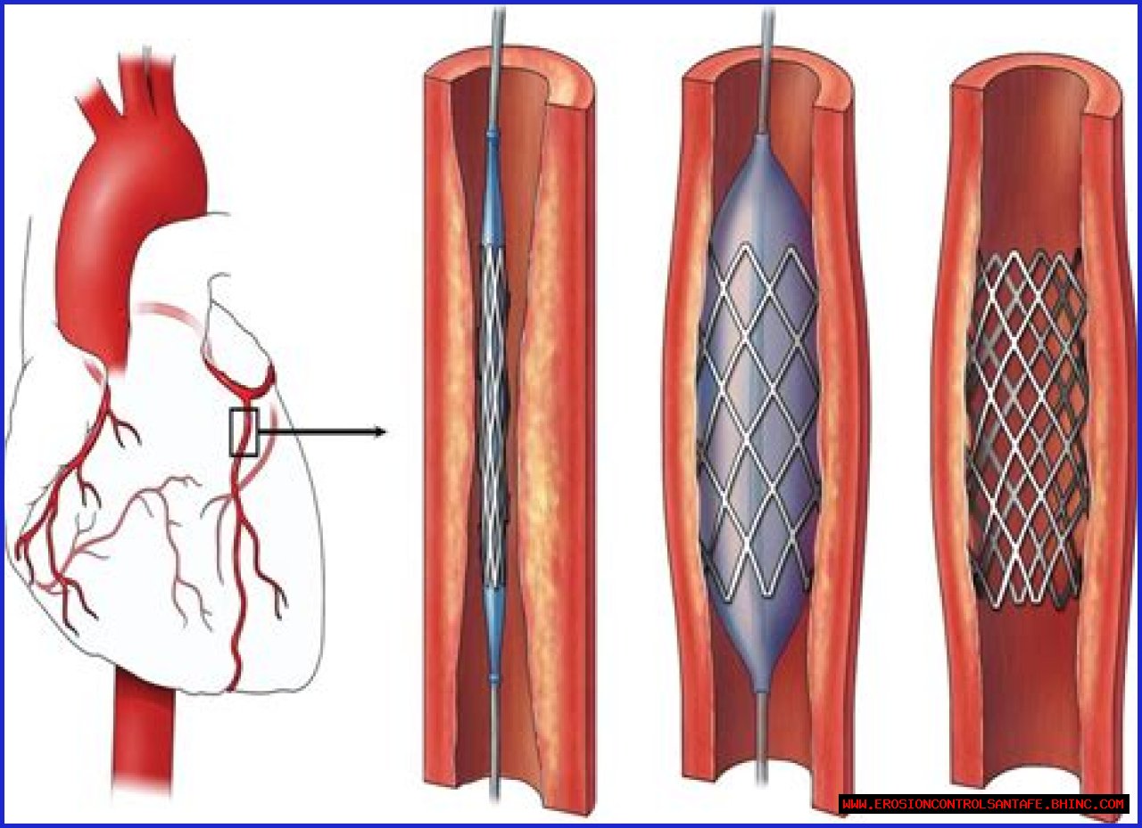 Which doctor does angioplasty?